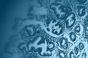 Histological tissue image representing cancer cells, used to illustrate how RNA-Seq is revolutionizing cancer research and precision medicine