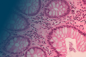 Combined RNA- and DNA-Seq multiomics enhances personalized cancer immunotherapy by enabling precise identification of potent neoantigens.